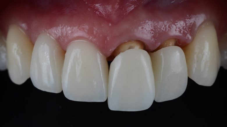 Esthetic Crowns