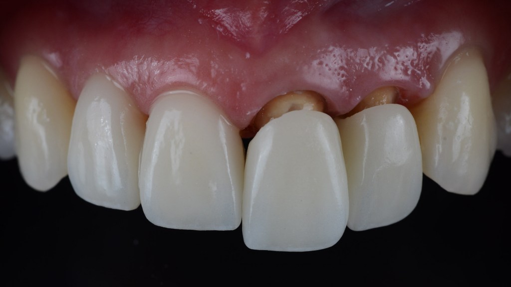 Esthetic Crowns