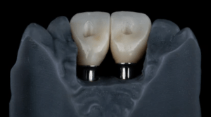 two model teeth
