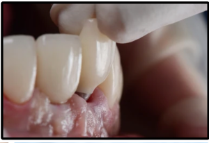 tooth model